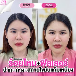 ประกาศ สินค้า เสริมความงามอุด ลดริ้วรอย ฉีดฟิลเลอร์อุดรธานี ยกกระชับ อุดร-ฉีดโบท็อก